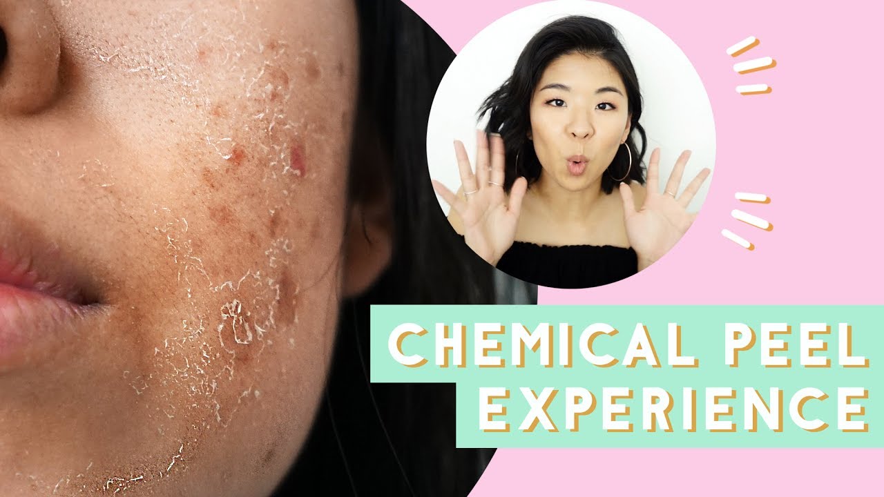 ✂ Chemical Peel for Acne & Scars