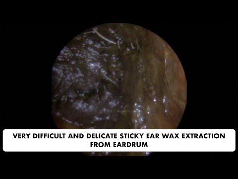 VERY DIFFICULT AND DELICATE STICKY EAR WAX REMOVAL FROM EARDRUM - Ep 30