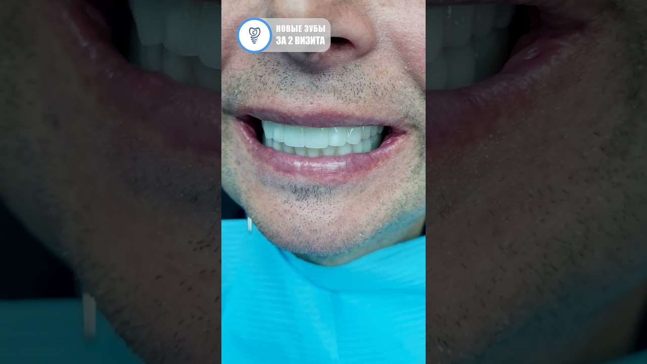 Вот такие зубы пациент получил сразу после операции. Имплантация зубов. 