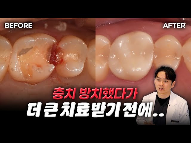 인레이 충치치료+신경치료 | 치과선택의 중요성✨