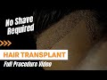 Dmcgolden touch technique for hair transplant  baldness treatment  dmc trichology