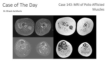 Case of the Day - 143 - MRI of Polio Afflicted Muscles