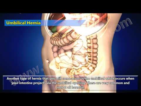 3D Video Of Different Types Of Hernia