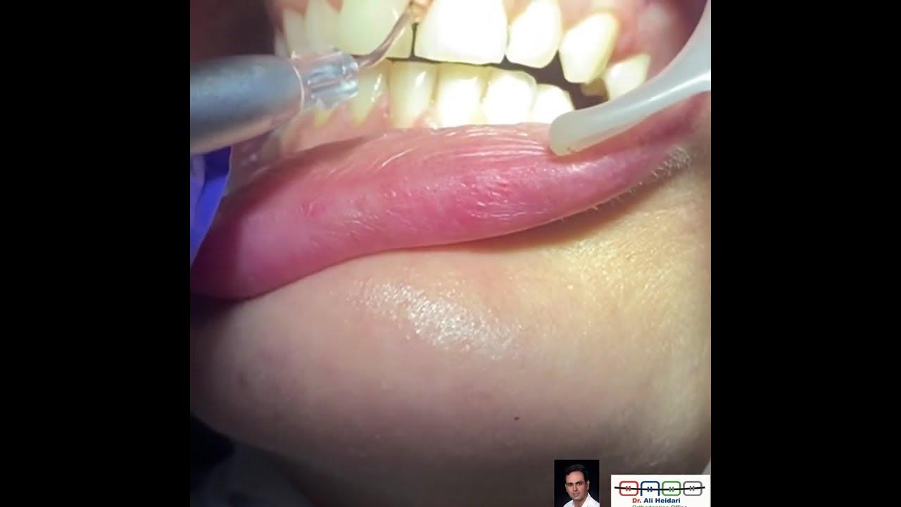 Diode laser frenectomy by epic 10,Dr Ali heidari YouTube