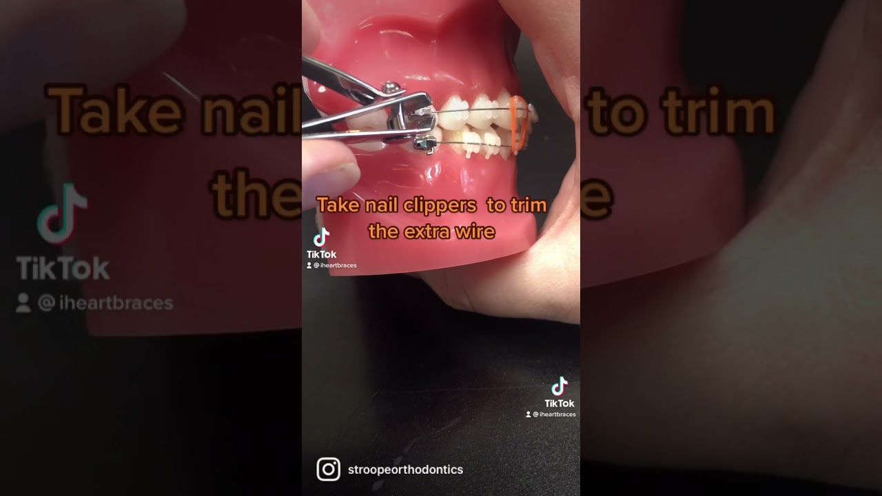 Top Braces Hack!