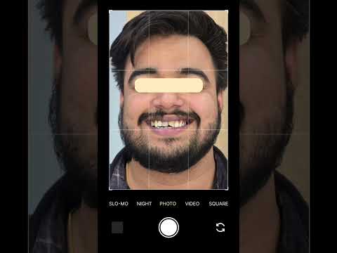 Smile Makeover at Surana Dental Clinic