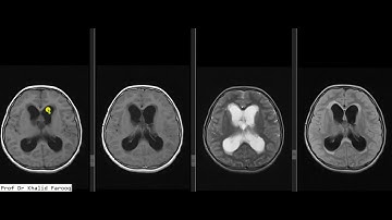 mri brain craniopharyngioma