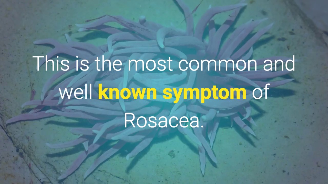 4 Major Symptoms Of Rosacea And How To Get Rid Of Rosacea - YouTube