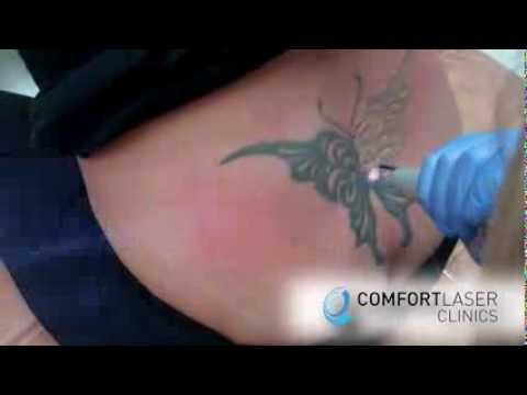 Laser Tattoo Removal on Lower-Back Tattoo by ComfortLaser