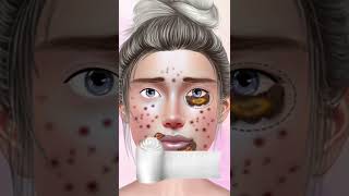 ASMR Giant Acne & Black Head Pimple Removal - Acne Deep Cleaning Animation