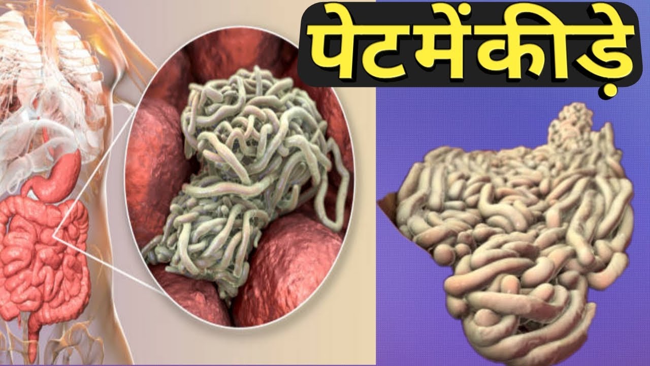 pinworm ka gharelu ilaaj chunne katne ka ilaj pet me kide