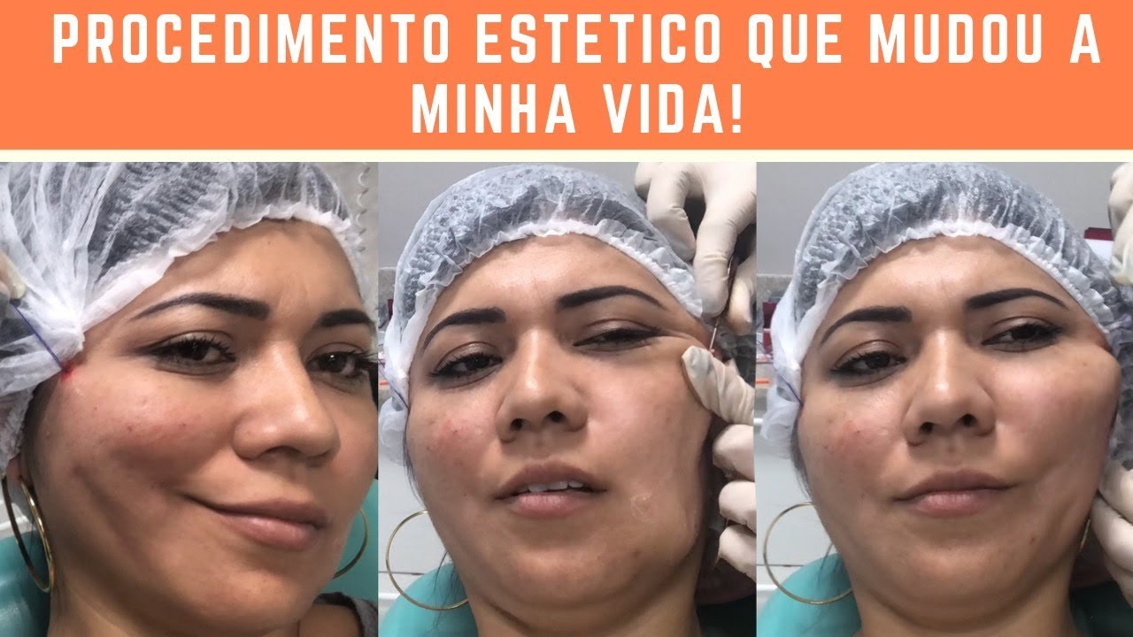 FIO DE PDO | COMO MODIFIQUEI MEU ROSTO SEM CIRURGIA PLÁSTICA? - YouTube