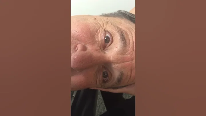 Horizontal Canal BPPV (Vertigo) - Watch the Eyes Go Wild! - DayDayNews