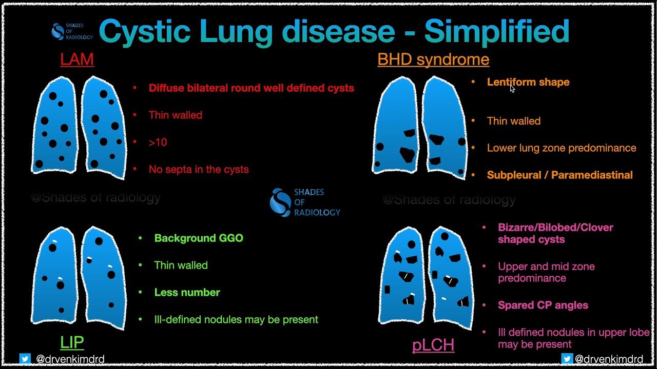lung-cysts-in-systemic-diseases-youtube