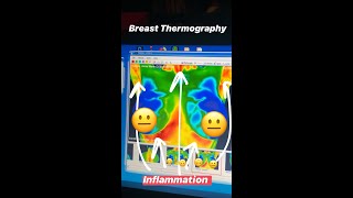 What is Breast Thermography? - Dr. Ana-Maria Temple, MD