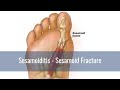 All about sesamoiditis