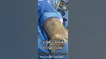 اسرع طريقة للتخسيس شفط دهون البطن دكتور محمد دنيا دكتور تجميل تنسق قوام شفط دهون جسم مثالي 