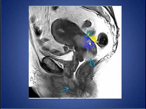 Video: Vaginal Cyste: Fjerningskirurgi, Foto, Diagnose