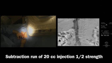 Insertion of Temporary IVC Filter