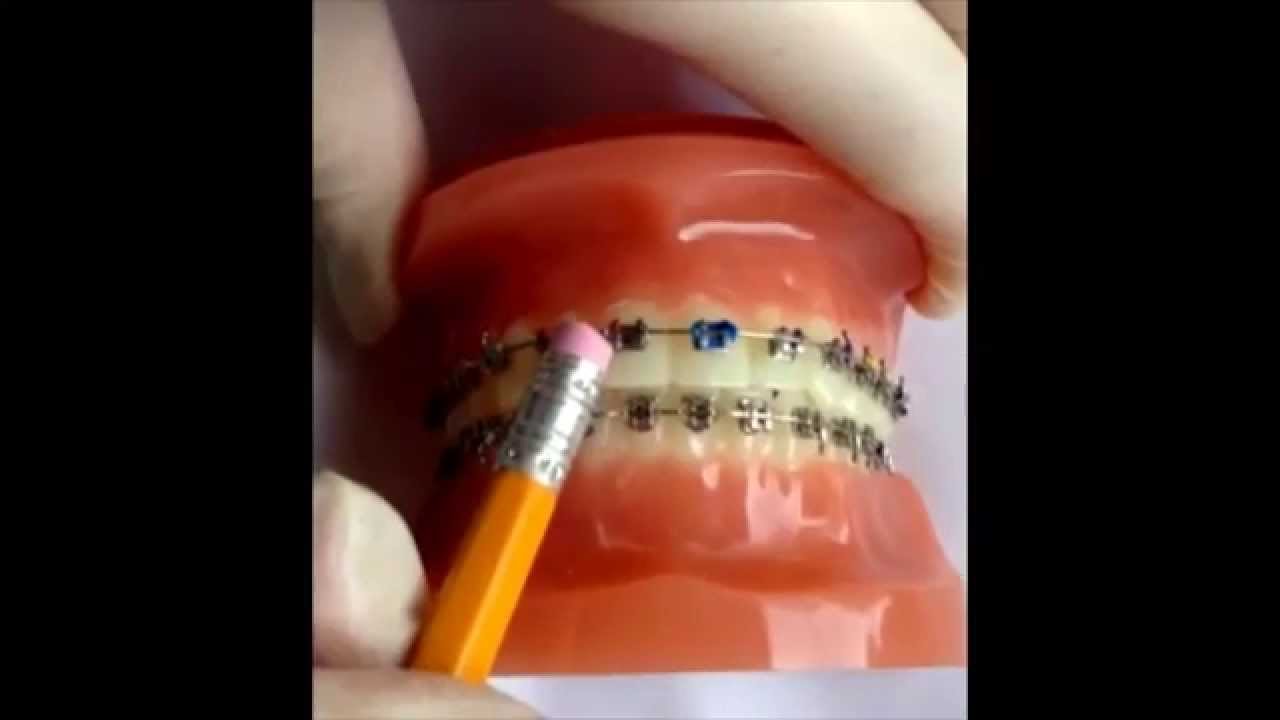 What to do if My Braces Wire Pokes Me?