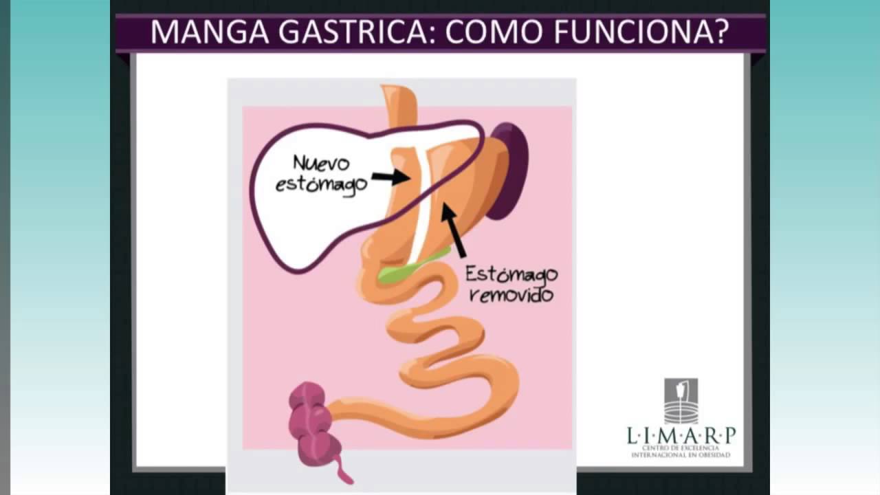 Cirugía de Manga Gástrica en quienes y como funciona YouTube