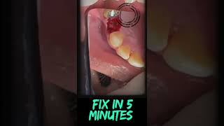 TTPHIL CONCEPT IMMEDIATE IMPLANTATION IMMEDIATE LOADING PROTOCOL