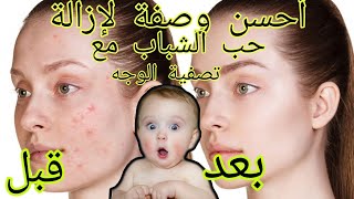 احسن وصفة لإزالة الحبوب (حب الشباب) و اثارها. ??