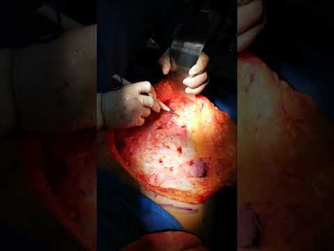 Vídeo: Què és la sutura no absorbible?