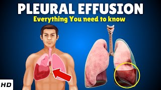 Pleural Effusion – Causes, Signs and Symptoms, Diagnosis & Treatment