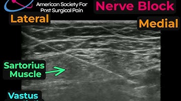 Saphenous Nerve Block at Mid Thigh