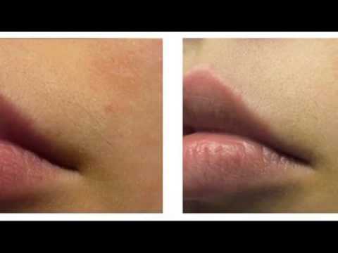 Bleach Upper Lip Hair Youtube