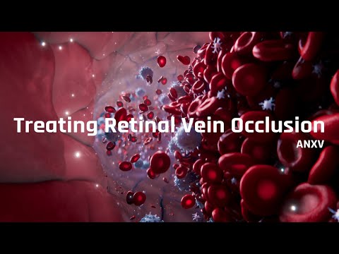Video: Lze okluzi větvené retinální žíly vyléčit?