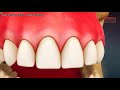 Soft tissue laser gingivectomy 3d animation - Dental Solutions Bangalore