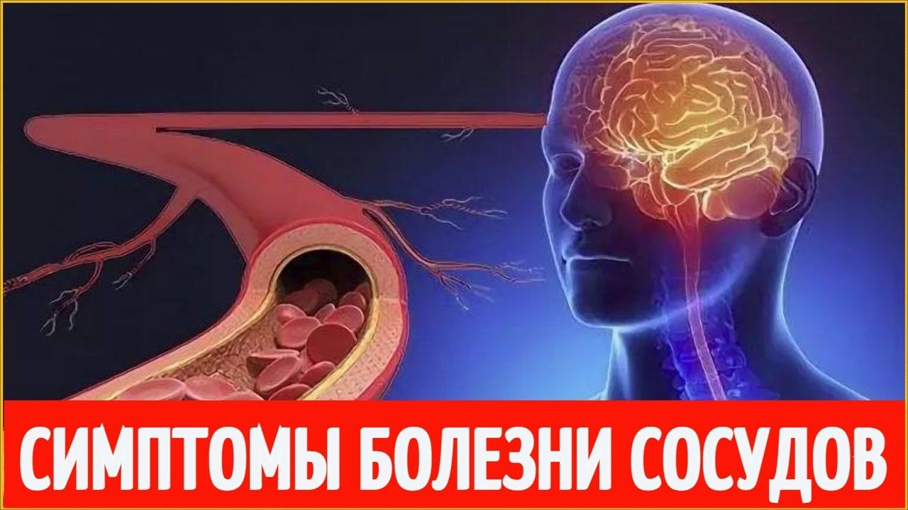 Болезни сосудов человека. Болезнь сосудов симптомы. Сосудистые заболевания симптомы. Как восстанавливаются сосуды.