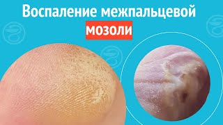 🦶 Воспаление Межпальцевой Мозоли. Клинический Случай №1250