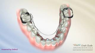 Bi Helix-Lower Orthodontic Appliance