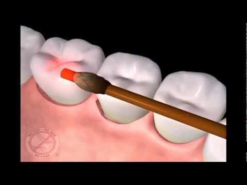 LANAP Patient Education - Laser Gum Therapy Period...