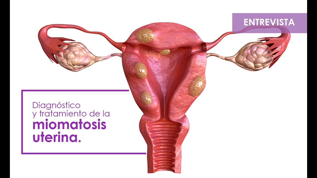Diagn stico Y Tratamiento De La Miomatosis Uterina YouTube diagn-stico-y-tratamiento-de-la-miomatosis-uterina-youtube
