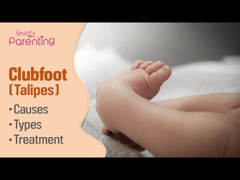 Video: Clubfoot In Children - Treatment, Massage, Signs Of Congenital Clubfoot