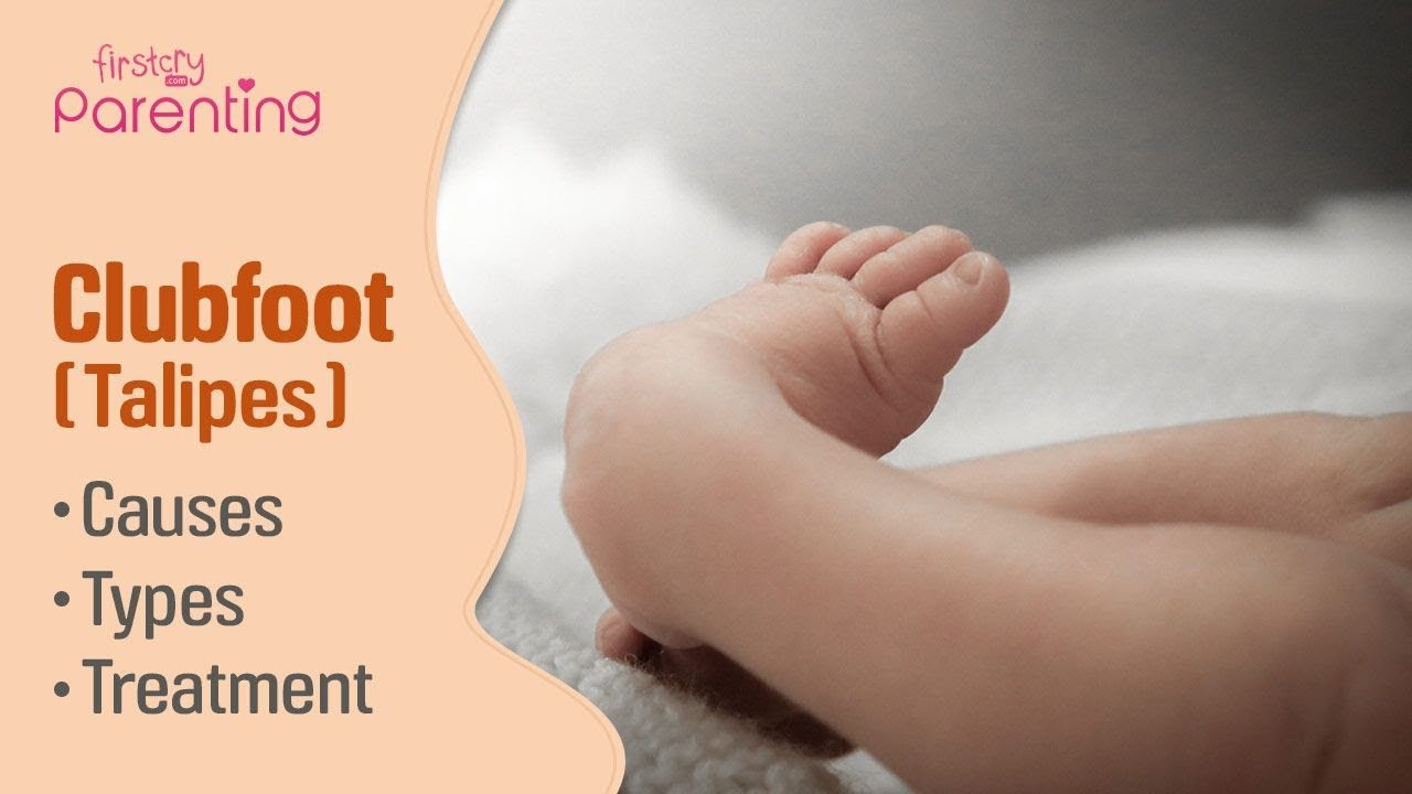 Club Foot Talipes In Babies Causes Signs Treatment Youtube