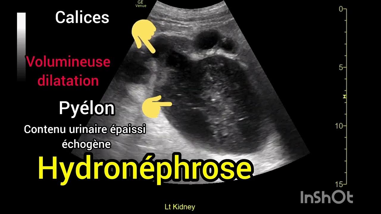 Hydronéphrose Dilatation pyélocalicielle majeure rein gauche Échographie YouTube