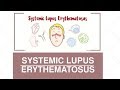 Lupus erythematosus: Ways to adapt to this immune disease