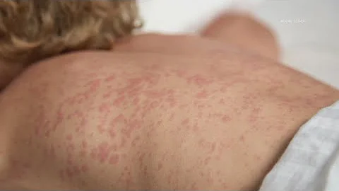 15 cases of measles reported in small West Texas county with high rate of vaccine exemptions