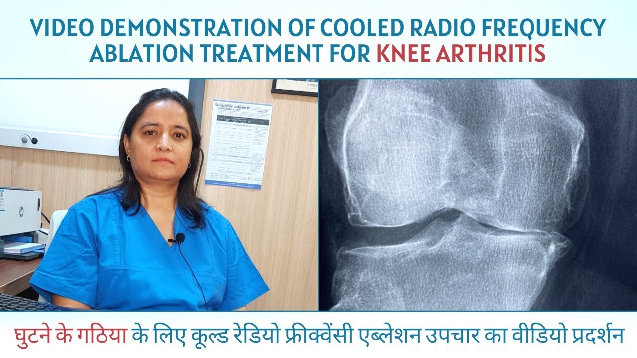 Video Demonstration Of Knee Radiofrequency Ablation Procedure II Video demonstration of knee radiofrequency ablation procedure ii