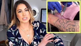 MY LASER TATTOO REMOVAL EXPERIENCE | Answering Questions