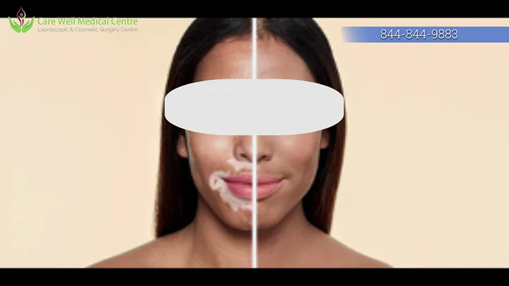 Vitiligo Treatment in Delhi Consult by Dr. Sandeep...