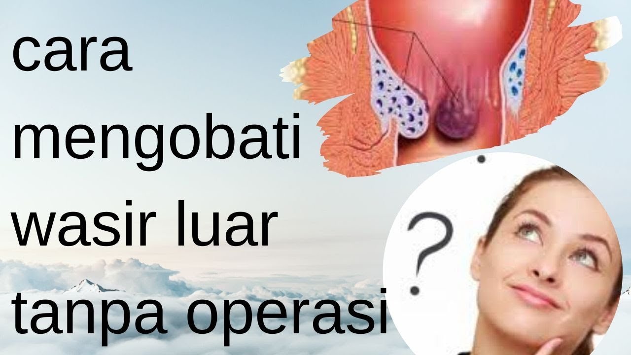cara mengobati wasir luar tanpa operasi