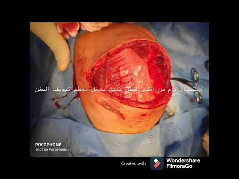 استئصال ورم الكلى ورم ولمز لطفل خديج يشغل معظم تجويف البطن