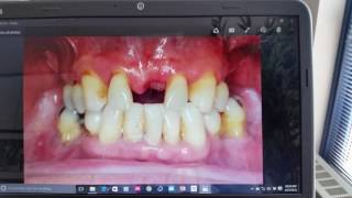 🔥Immediate Dentures : the right way 🔥 Dr.  Derek Gatta : #dentistry #prosthodontics #smilemakeover