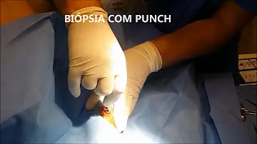 Qual o exame para detectar a psoríase?